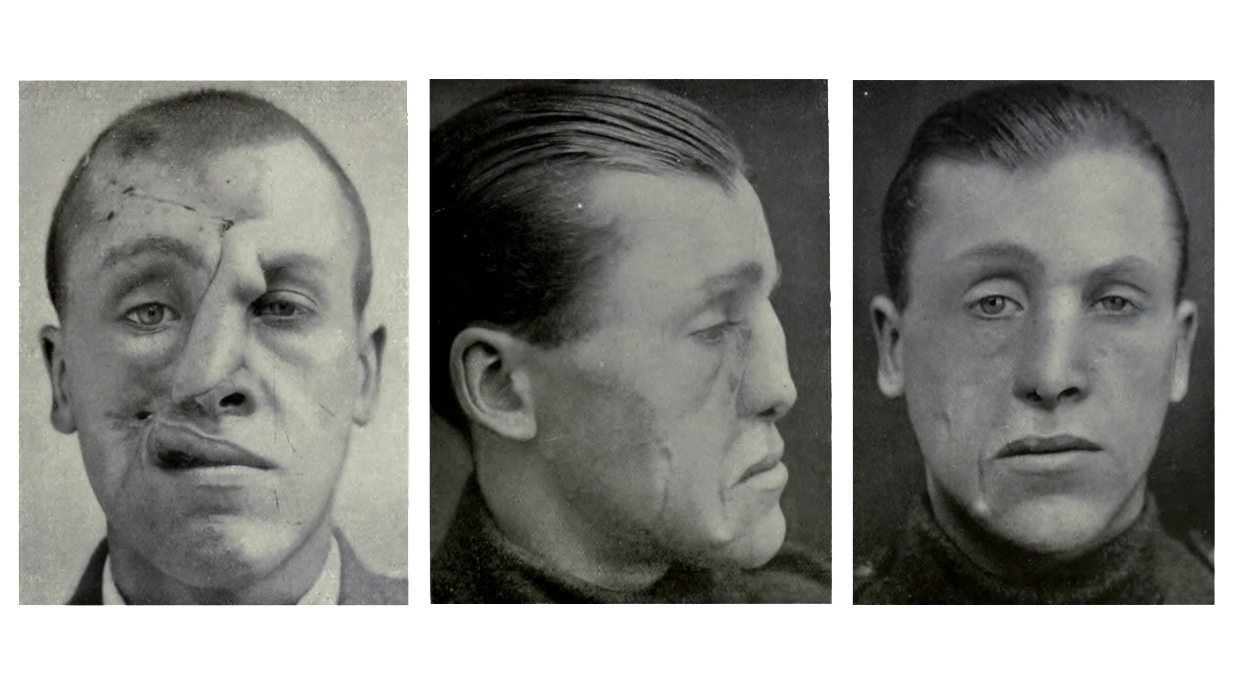 Innovative Cosmetic Surgery Restored WWI Vets' Ravaged Faces—And Lives