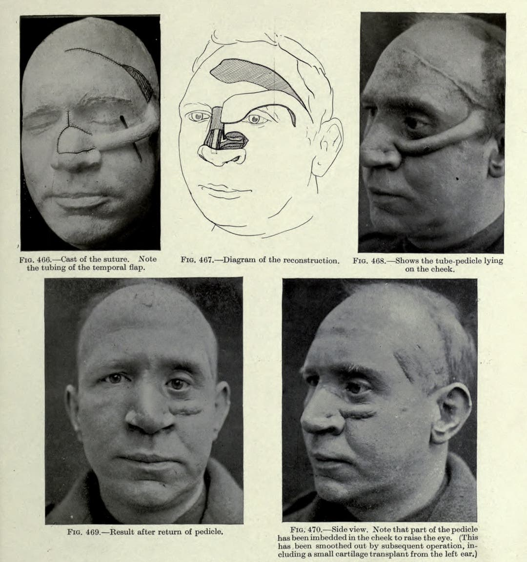 Innovative Cosmetic Surgery Restored WWI Vets Ravaged Faces And Lives innovative-cosmetic-surgery-restored-wwi-vets-ravaged-faces-and-lives